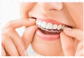 Invisible Aligners (Clear & Removable)