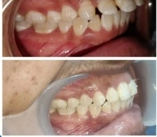Severe Crowding & Alignment Correction