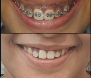 Braces & Deep Bite Correction