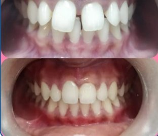 Diastema & Central Gap Closure