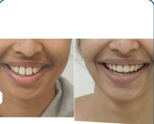 Smile Widening & Crooked Teeth