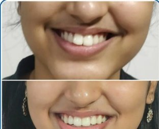 Complete Smile Makeover